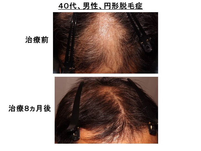 円形脱毛症　名医""